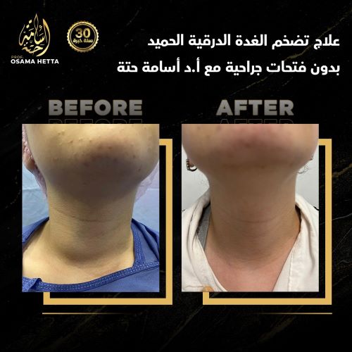 علاج تضخم الغدة الدرقية بالأشعة التداخلية